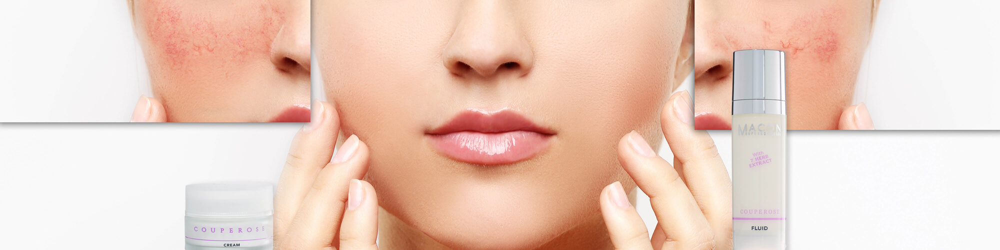 Couperose